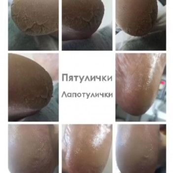 Обробка п'яток