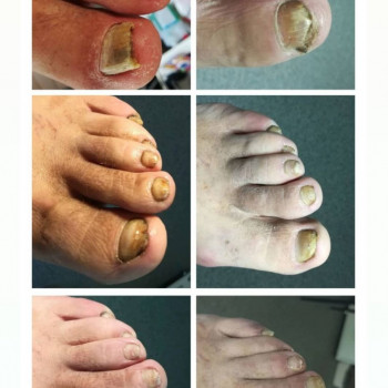 Оніхомікоз