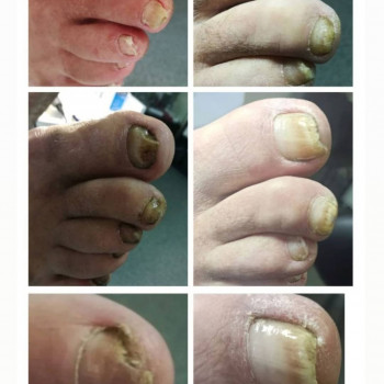 Оніхомікоз