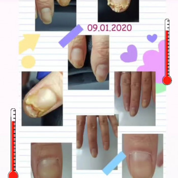 Оніхомікоз