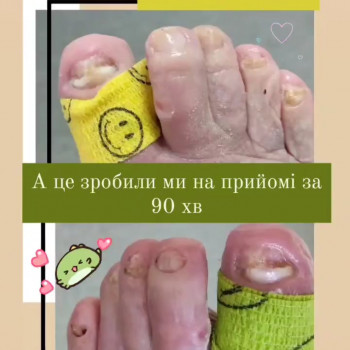 Оніхогрифоз
Після
Оніхомікоз
 
 
 
 
 
 