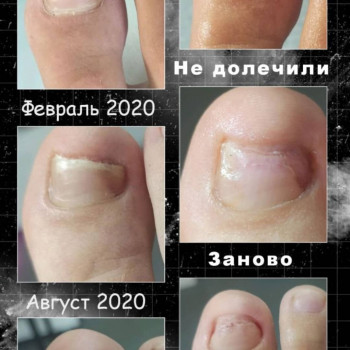 Оніхомікоз
 
 
 
 
 
 