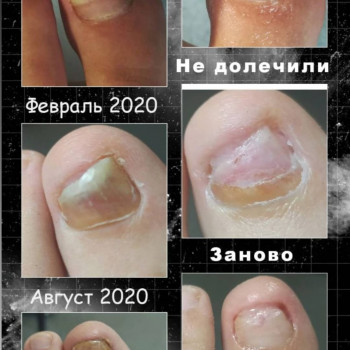 Оніхомікоз
 
 
 
 
 
 