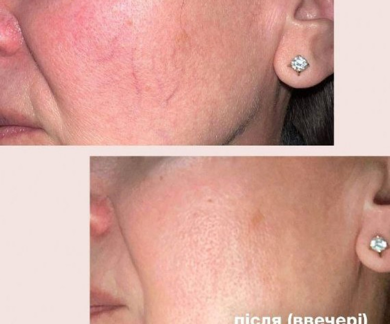 Удаление купероза (сосудистой сетки) ipl lumeca, фото - Медичний центр Медицинский Центр ДОКАРТ