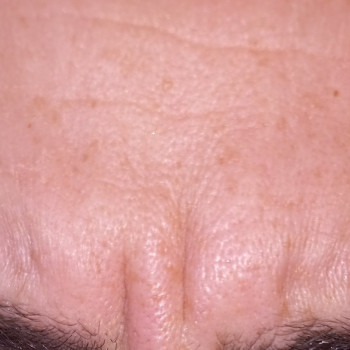 Вертикальные морщины на переносице