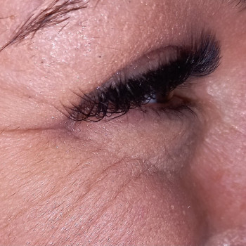 Гусиные лапки
Рагладим при помощи Botox