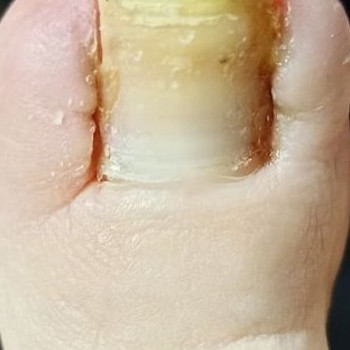 Врослий ніготь
Після