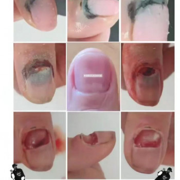 Травма нігтя