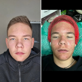 Чистка лица, Hydrofacial, ультразвуковая, механическая чистка
                    Косметолог-эстетист Влада Харьков