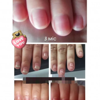 Оніхомікоз