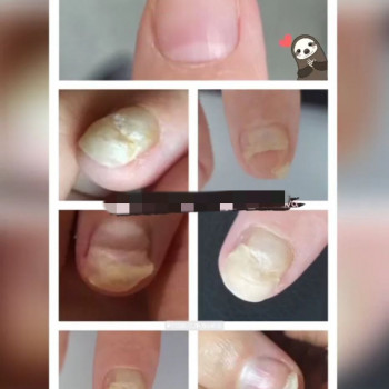 Оніхомікоз