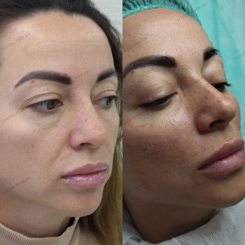 Бьютифікація обличчя, комплекс процедур