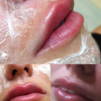 Зміна форми губ, аугментація губ.