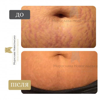 лазерне видалення розтяжок