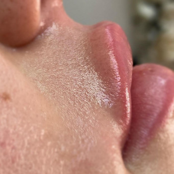 Фото після 
Видалення вусиків воском 100 грн