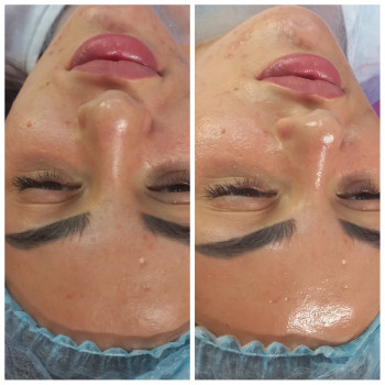 Комплекс Ультразвукова чистка + Карбокситерапія
                    Косметолог Лілія Винница