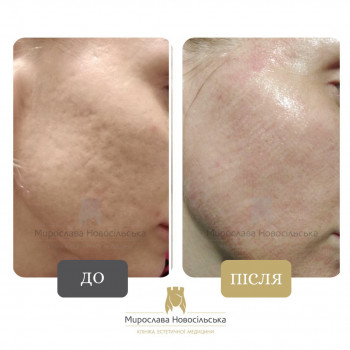 Лазерне шліфування рубців та постакне
                    Косметологический центр Клініка естетичної медицини Мирослави Новосільської Ужгород