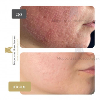Лазерне шліфування рубців та постакне
                    Косметологический центр Клініка естетичної медицини Мирослави Новосільської Ужгород