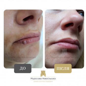 Лазерне видалення доброякісних новоутворів (папіломи, бородавки, гемангіоми)
                    Косметологический центр Клініка естетичної медицини Мирослави Новосільської Ужгород