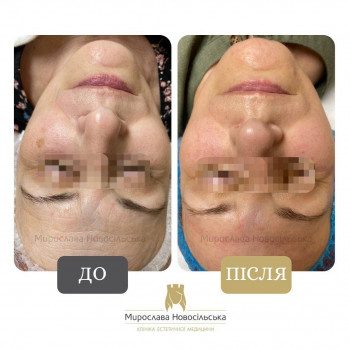Лазерне фракційне 4D омолодження
                    Косметологический центр Клініка естетичної медицини Мирослави Новосільської Ужгород