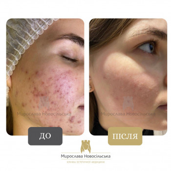 Лазерне шліфування рубців та постакне
                    Косметологический центр Клініка естетичної медицини Мирослави Новосільської Ужгород