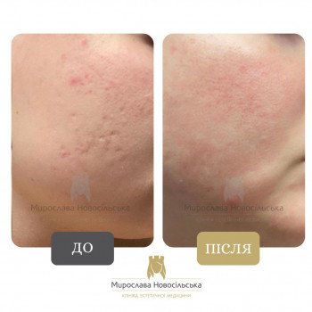 Лазерне видалення шрамів, рубців
                    Косметологический центр Клініка естетичної медицини Мирослави Новосільської Ужгород