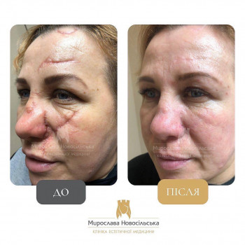 Лазерне видалення шрамів, рубців
                    Косметологический центр Клініка естетичної медицини Мирослави Новосільської Ужгород