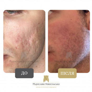 Лазерне видалення шрамів, рубців
                    Косметологический центр Клініка естетичної медицини Мирослави Новосільської Ужгород