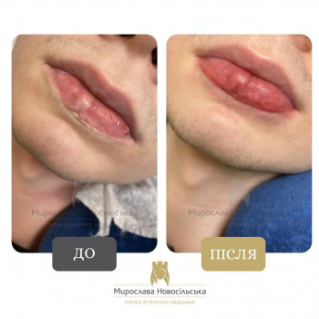Перманентний макіяж брів, губ та повік
                    Косметологический центр Клініка естетичної медицини Мирослави Новосільської Ужгород