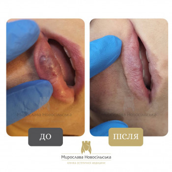 Лазерне видалення доброякісних новоутворів (папіломи, бородавки, гемангіоми)
                    Косметологический центр Клініка естетичної медицини Мирослави Новосільської Ужгород