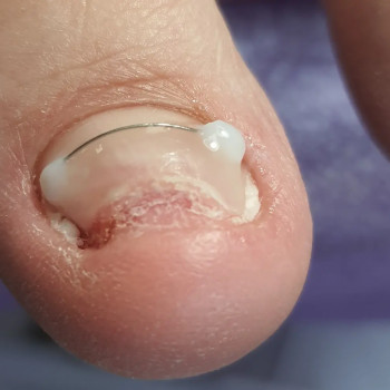 Корегуюча система "Титановая Нитка"
                    Подолог Светланa Днепр