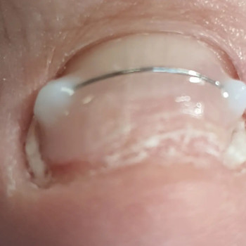 Корегуюча система "Титановая Нитка"
                    Подолог Светланa Днепр