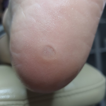 Обробка Бородавки
                    Подолог Светланa Днепр