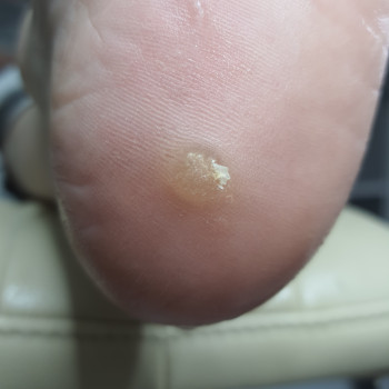 Обробка Бородавки
                    Подолог Светланa Днепр