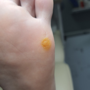 Обробка Бородавки
                    Подолог Светланa Днепр