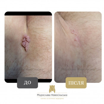 Лазерне видалення на інтимних зонах (однією процедурою)