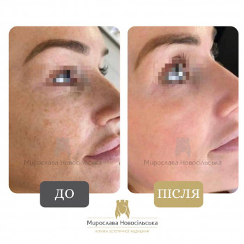 Лазерне видалення пігментації
                    Косметологический центр Клініка естетичної медицини Мирослави Новосільської Ужгород