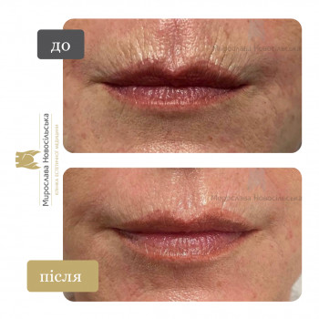 Лазерне шліфування рубців та постакне
                    Косметологический центр Клініка естетичної медицини Мирослави Новосільської Ужгород