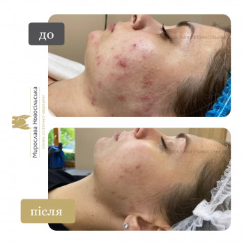 Лікування акне Clear Skin
                    Косметологический центр Клініка естетичної медицини Мирослави Новосільської Ужгород