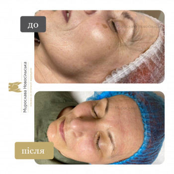 Лазерне фракційне 4D омолодження
                    Косметологический центр Клініка естетичної медицини Мирослави Новосільської Ужгород