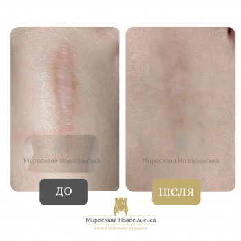 Лазерне шліфування рубців та постакне
                    Косметологический центр Клініка естетичної медицини Мирослави Новосільської Ужгород