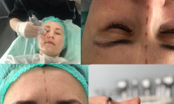 RF lifting Косметолог Міла Київ