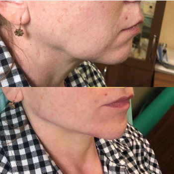 Нитковий ліфтинг
                    Перукарня Надия Кривий Ріг