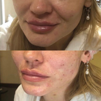 Нитковий ліфтинг
                    Перукарня Надия Кривий Ріг