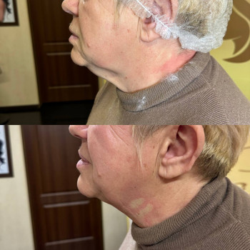 Нитковий ліфтинг
                    Перукарня Надия Кривий Ріг