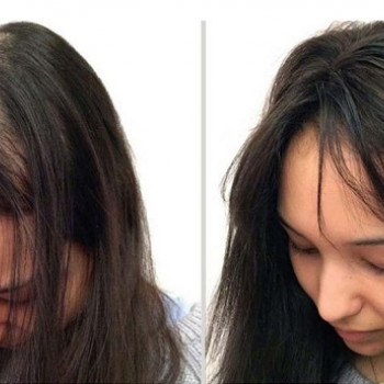 Гніздова алопеція