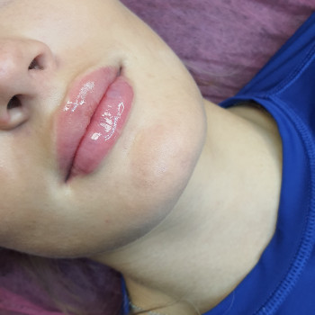 Контурна пластика губ