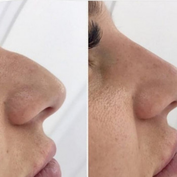 коррекция носа филлерами