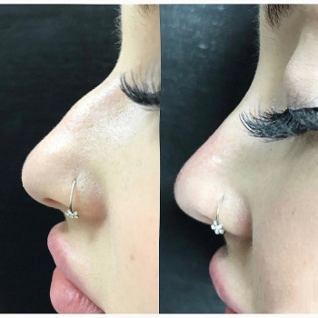 коррекция носа филлерами