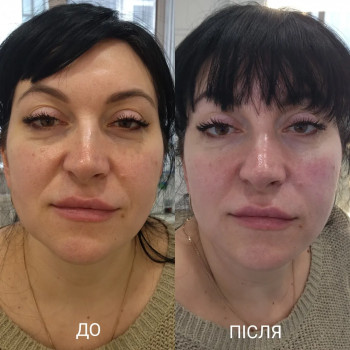 Апаратна карбоксітерапія
                    Косметолог Міла Київ